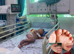 TP.HCM: Virus gây bệnh tay chân miệng nặng ở trẻ em tái xuất