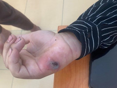 Điện Biên phát hiện 3 ổ dịch bệnh than trên người, Bộ Y tế vào cuộc