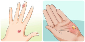 Cách chữa vết bỏng bị phồng rộp hết rát và nhanh lành