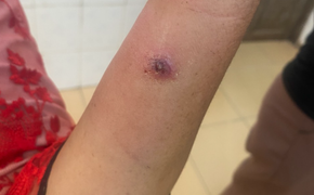 Điện Biên ghi nhận ca bệnh than thứ 14, là trẻ nhỏ 2 tuổi