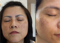 Bộ 3 sản phẩm Hi Beauty hỗ trợ mờ nám, sáng da, trả lại nét đẹp thanh xuân