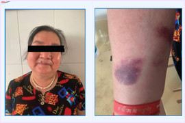 Dùng thuốc giảm đau không rõ nguồn gốc, người phụ nữ nhập viện cấp cứu