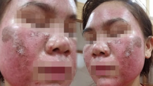 Mặt bỏng rát, bong tróc như da rắn sau khi bôi thuốc tại spa