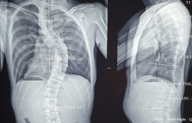 Đừng để lưng trẻ quá cong mới đi khám