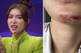 Người mẫu Minh Tú bị flycam đập vào mặt, khâu hơn 10 mũi