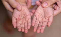 Trẻ mắc tay chân miệng tăng vọt, nguy cơ lây từ người lớn