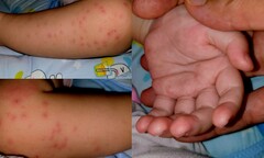 TP.HCM nguy cơ thiếu thuốc điều trị bệnh tay chân miệng