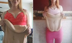 Cô gái muốn khóc thét với vùng bụng 'chảy như thác nước' sau khi giảm 82kg