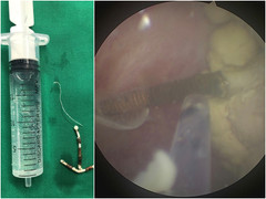 Vòng tránh thai ‘đi lạc’ vào bàng quang