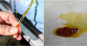 Rùng mình sán bò trong ống dẫn lưu của bệnh nhân sau thủ thuật