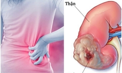5 dấu hiệu cảnh báo ung thư thận không nên bỏ qua