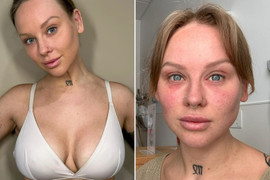 Người phụ nữ Anh mất thị lực sau khi phẫu thuật nâng ngực