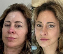 Quý bà 50 tuổi bán nhà để phẫu thuật thẩm mỹ lấy lại tuổi xuân