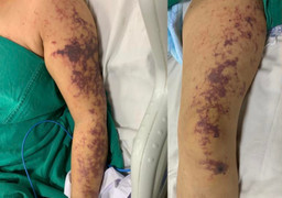 Suýt chết vì món ăn khoái khẩu của người Việt