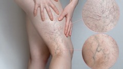  Bệnh suy giãn tĩnh mạch có thể gây tử vong