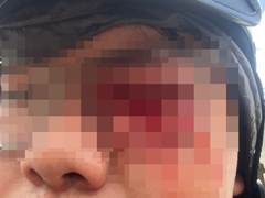 Mời làm việc với thanh niên ‘tố’ chấn thương mắt vì gậy của CSGT