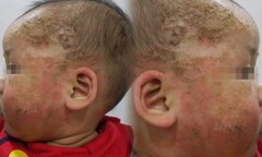 Bố mẹ dùng lá tắm điều trị con bị viêm da cơ địa, bé 8 tháng tuổi loét mặt 