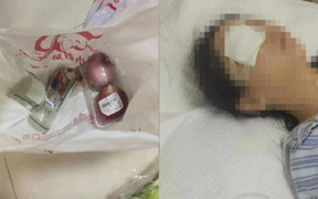 Cô gái dập nát nhãn cầu khi chai nước ngọt mua qua mạng nổ tung 