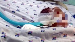 Bé trai bị bảo mẫu bạo hành dập não đã qua đời