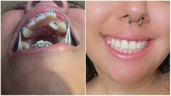 20 bức ảnh chứng minh niềng răng thay đổi nụ cười của bạn ra sao