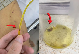 Thích ăn gỏi cá, sán lá gan chui ra từ ống dẫn lưu đường mật