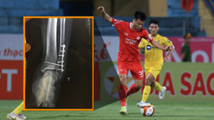 Nghị lực đáng nể của tân binh tuyển Việt Nam từng bị đóng 6 chiếc đinh ở cổ chân