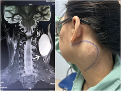 Cô gái 18 tuổi ám ảnh khối u lớn ở cổ suốt 7 năm