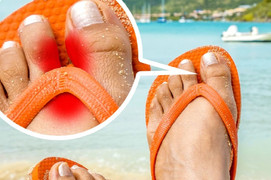 Thường xuyên đi dép xỏ ngón có hại gì?