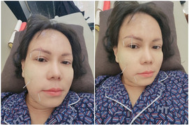 Sao Việt không may bị liệt nửa mặt, có người đứng trước nguy cơ đột quỵ