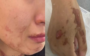 Đòi đầu bếp 'múa lửa' tại bàn để quay clip, cô gái bị bỏng nặng 