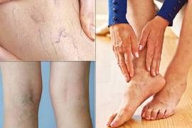 Sản phẩm từ Holistica Pháp hỗ trợ bệnh suy giãn tĩnh mạch