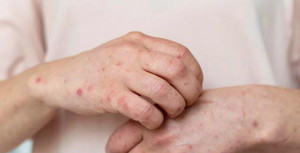 TP.HCM ghi nhận ca mắc đậu mùa khỉ thứ 5 