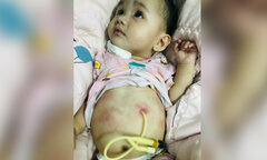 Cô bé dân tộc Mông bị dị tật, bố mẹ nghèo xin con ra viện về nhà chờ chết