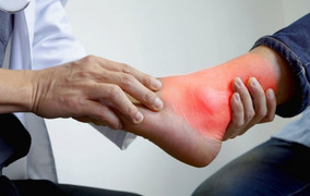 Bệnh gout có xu hướng trẻ hóa, bác sĩ chỉ cách phòng ngừa
