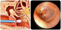 Hậu quả của việc thường xuyên ngoáy tai