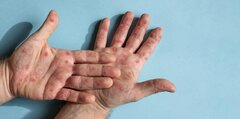 Ca tử vong đầu tiên liên quan đậu mùa khỉ tại TP.HCM