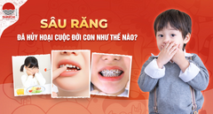 Sâu răng ở trẻ gây nhiều tác hại nguy hiểm hơn cha mẹ nghĩ