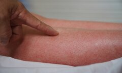 Thời điểm nào nguy hiểm nhất khi mắc sốt xuất huyết?