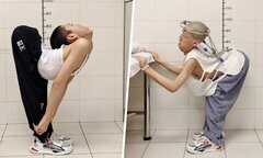 Hành trình duỗi thẳng lưng cho chàng trai có cột sống cong hình chữ Z
