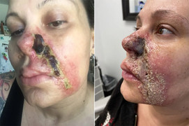 Nghiện tiêm filler, người phụ nữ bị mục nát và rụng một bên mũi
