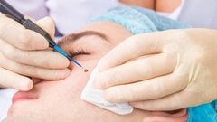 Có nên xóa nhiều nốt ruồi một lúc?