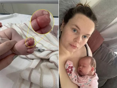 Em bé sơ sinh suýt mất ngón chân chỉ vì sợi tóc của mẹ