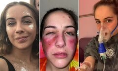 Cô gái siêu dị ứng, chỉ cần cười nhiều hay nổi cáu là làn da như bị tạt axit