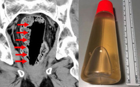 Người đàn ông bất tỉnh trong bồn tắm khi chữa táo bón bằng cách 'kinh dị'