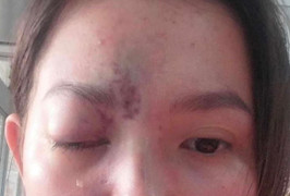 Mù một bên mắt sau khi tiêm filler làm đẹp