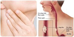 Những dấu hiệu ung thư thực quản giai đoạn đầu bạn không thể chủ quan