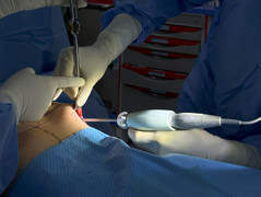 Kỹ thuật tạo khoang đúng với kích cỡ túi ngực trong nâng ngực