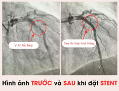Ngỡ ngàng phát hiện hẹp nặng động mạch vành khi vào viện điều trị cúm