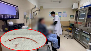 Hy hữu người đàn ông mắc xương cá dài 3,5 cm ở tai 
