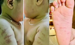 Hai trẻ bị bạo hành tại cơ sở mầm non ở Bình Định: Giáo viên nhận lỗi